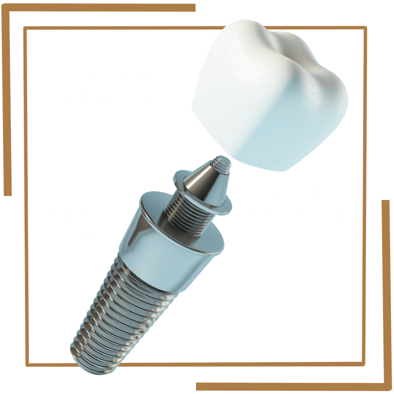 3 parts of dental implant