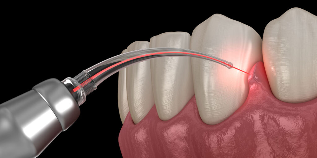 Dental Laser