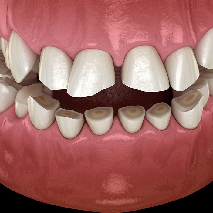 Bruxism