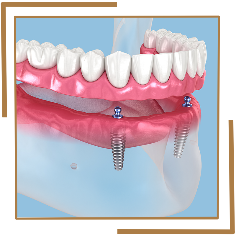 Denture Implants