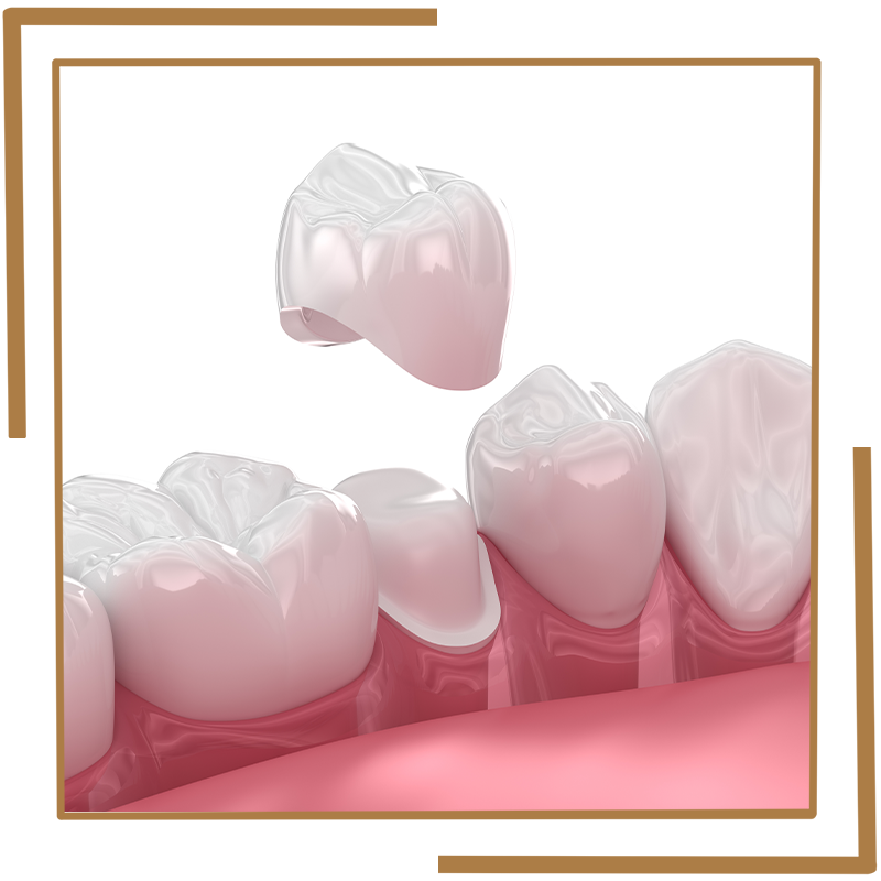 Dental crowns
