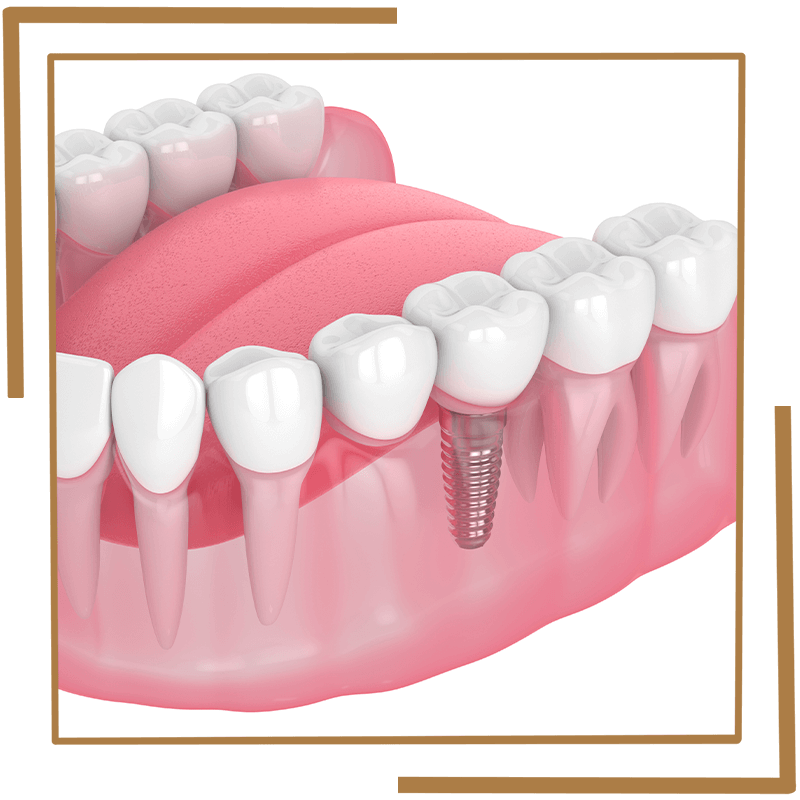 Dental Implants