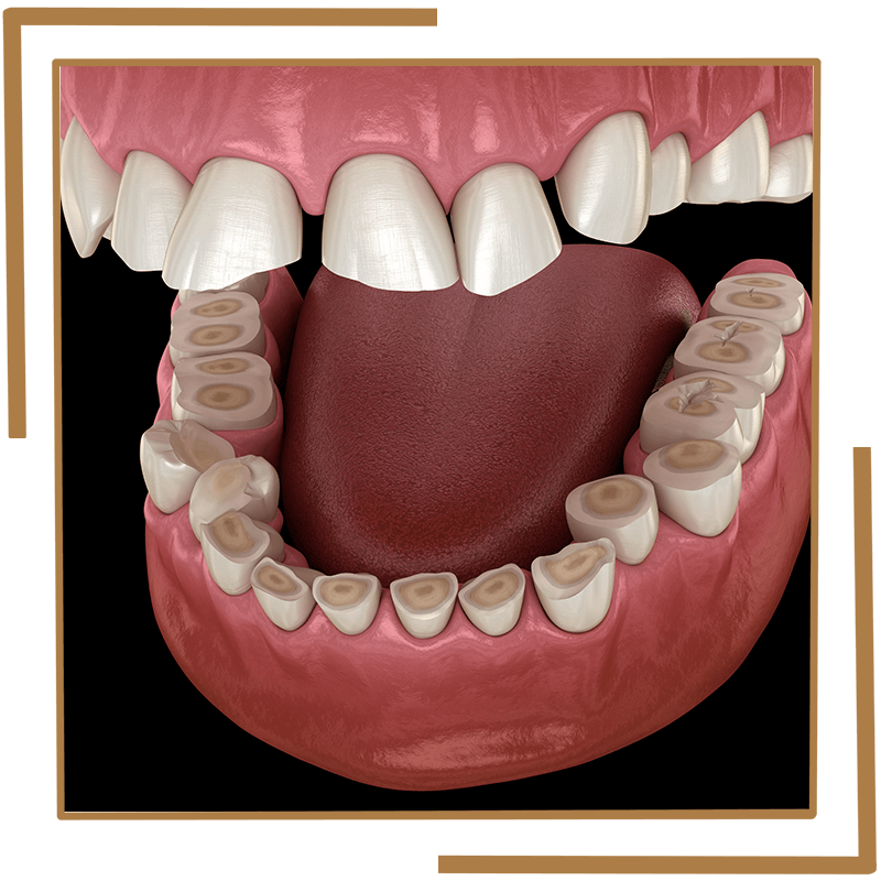 Bruxism