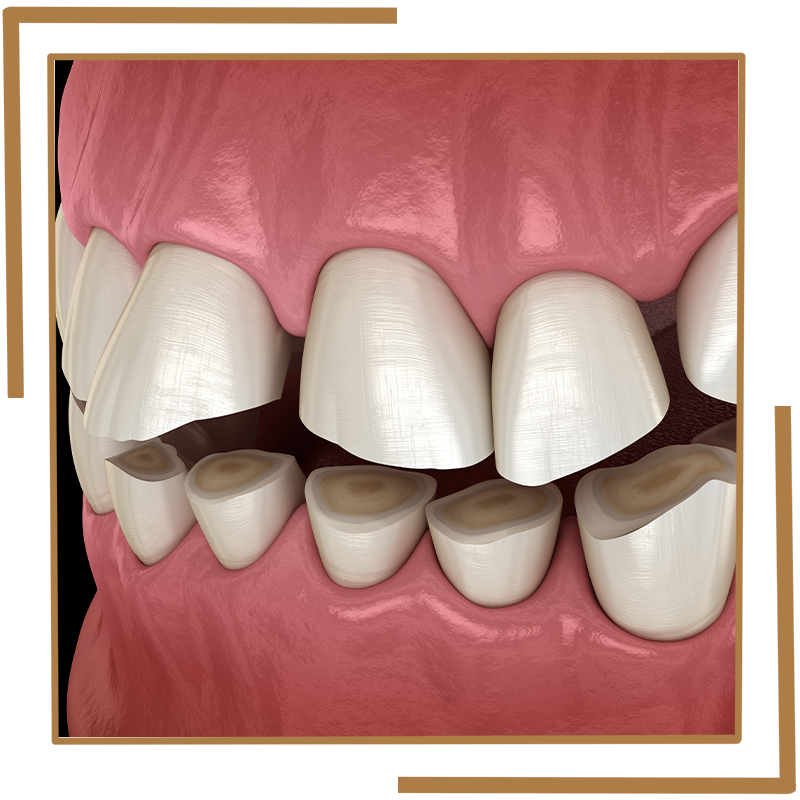 Grinding teeth