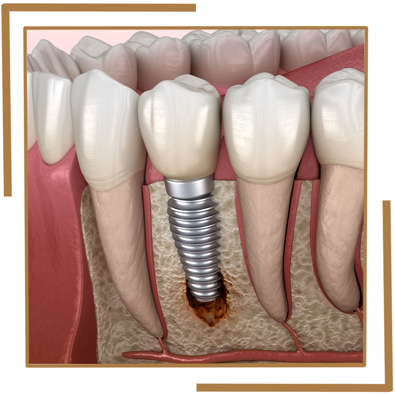 Peri-Implantitis
