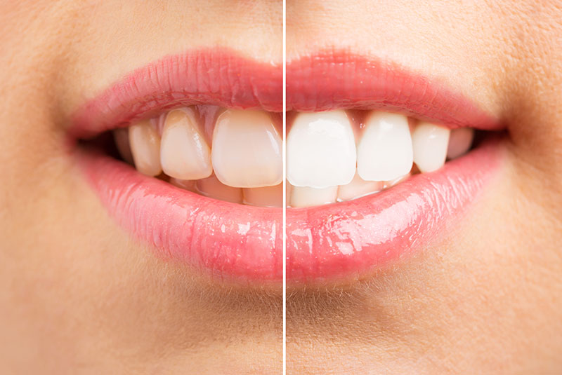 Teeth Whitening