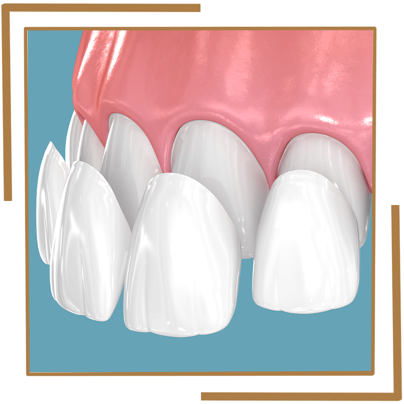 Veneers